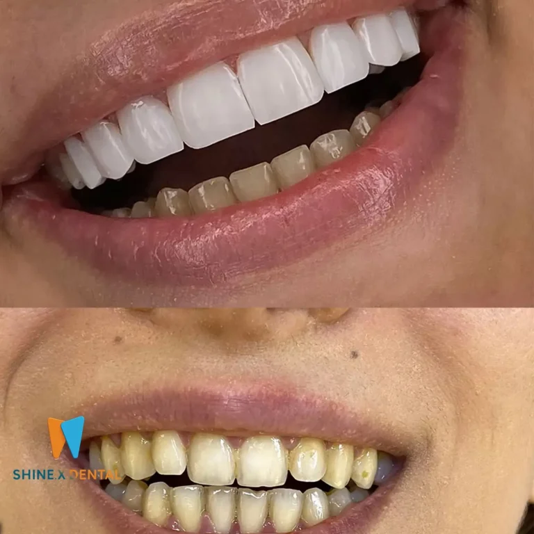 عکس قبل و بعد کامپوزیت دندان