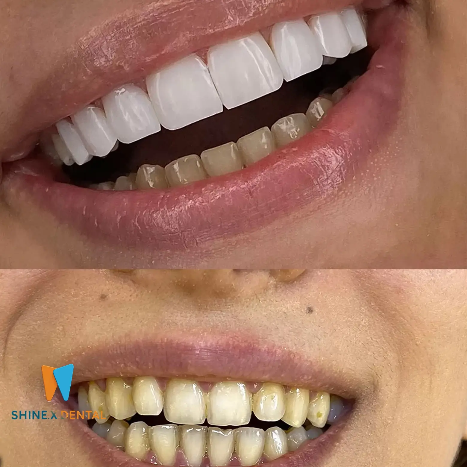 عکس قبل و بعد کامپوزیت دندان